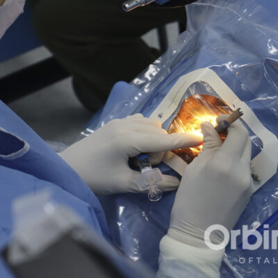 Facoemulsificación Facoemulsificación